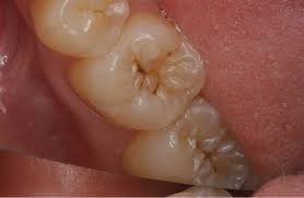 We can conduct an examination and provide. Ways To Tell If You Have A Cavity