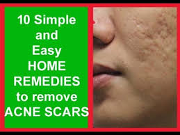 10 home remes for acne scars