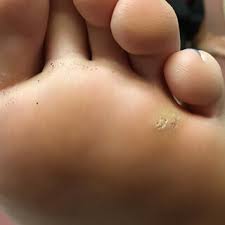 pdf plantar warts epidemiology