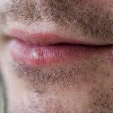 garlic to wipe out cold sores
