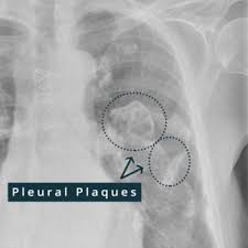 , this condition manifests with nonspecific symptoms, e.g., coughing and. Pleural Plaques Causes Symptoms Diagnosis Treatment