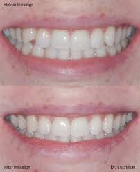 Invisalign offers a 0.2 mm movement per aligner. Before And After Invisalign Mild Crowding Viechnicki Orthodontics