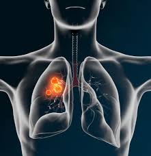 Metastatic cancer to the lungs is much more common than primary lung cancer. How Long Does Chemo Prolong Life In Lung Cancer Patients Lung Cancer Pintas Mullins Law Firm
