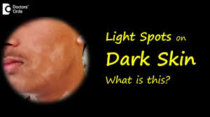 light spots patches on brown or dark