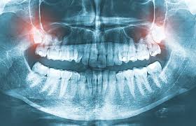 escondido impacted wisdom teeth removal