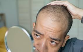 arthritis cations may cause hair loss