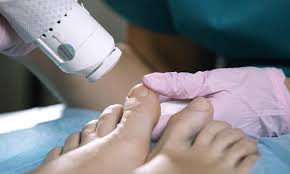 does laser toenail fungus removal work