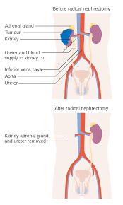 Nephrectomy Wikipedia