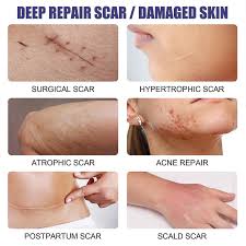 scar hyperplasia scar silicone repair