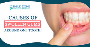 swollen gums around one tooth causes