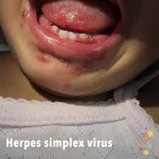herpes simplex virus skin deep