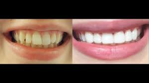 An alternative treatment to braces. How To Get Instant Straight Teeth Without Braces Veneers Whitening Experience Before And After Youtube