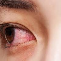 eye infections 5 home remes for