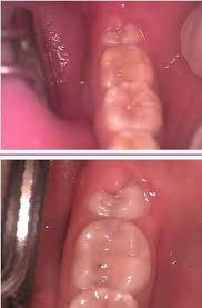 extraction of erupted wisdom teeth and