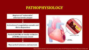 Schematic diagram pathophysiology of myocardial infarction. St Elevation Myocardial Infarction