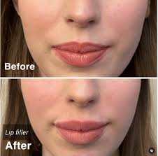 lip filler injections how long do they