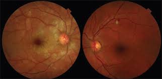 Image result for fundus examination of eye