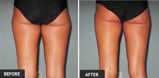 st louis thigh lipo costs and