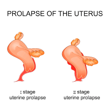 how to heal a uterine prolapse your