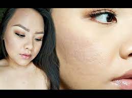 how to minimize indented acne scars
