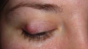home remes for eyelid cysts