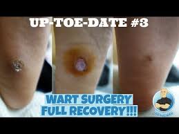 plantar wart removal surgery for 7 year