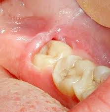 pericorinitis smile creation dental