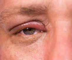 styes causes and treatments atlantic
