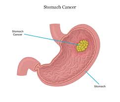 Stomach cancer, or gastric cancer, is a fairly uncommon type of cancer. Stomach Cancer Symptoms Causes Stages Treatment And Survival Rates