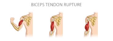 biceps tendon rupture overview