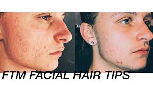 Dht also drives genital growth, body hair growth, and male pattern baldness. Ftm Facial Hair Growth One Month On Minoxidil Q A By Noah Hella
