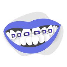 Braces — braces are commonly used in conjunction with both of the above procedures. Can Braces Correct Adult Underbite Smile Prep