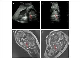 fetal brain magnetic resonance imaging