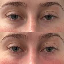 non surgical eyelid lift in nyc and