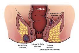 peri abscess colorectal clinic of