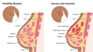 Sharp pain under your right breast could be connected with injury to a rib or the inflammation of the muscles, bones, or cartilage. Mastitis While Breastfeeding Causes Symptoms Treatments
