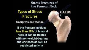 stress fractures of the fem neck