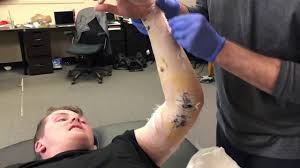 Uclr is open surgery and requires general rehabilitation after uclr surgery usually occurs in three phases. Tommy John Surgery 1st Day Of Physical Therapy Youtube