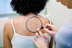 The strongest risk factor for developing skin cancer is ultraviolet (uv) ray exposure, typically from the sun. Patients With Deadliest Skin Cancer To Get Breakthrough Drug On Nhs That Slashes Risk Of Death In Half