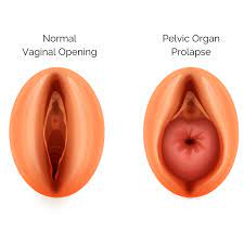 pelvic organ prolapse advanced urology