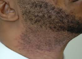 Risks of laser hair removal on dark skin. Is Laser Hair Removal Safe For Black Skin