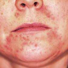 Acne products are used for the treatment of mild to moderate acne vulgaris. Patient Caught In Vicious Cycle With Perioral Rash Clinician Reviews