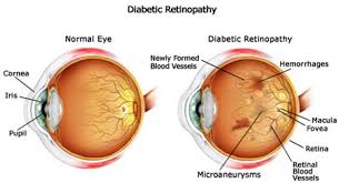 diabetic retinopathy eye disease