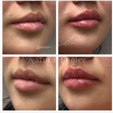 lip filler natural self