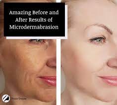 5 before and after microdermabrasion
