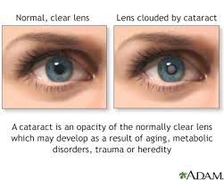 cataract removal information mount