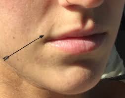 fix this indentation on my upper lip