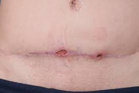 Procedure, reasons, recovery, and complications. Post Cesarean Wound Infection Causes And Treatment