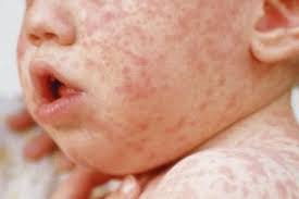 They often appear as blotchy red spots. Rashes In Babies And Children Nhs