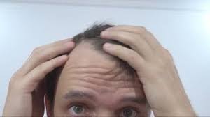 stress can cause hair loss here s what